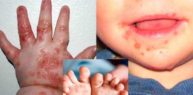 bệnh chân tay miệng của trẻ em cần lưu ý